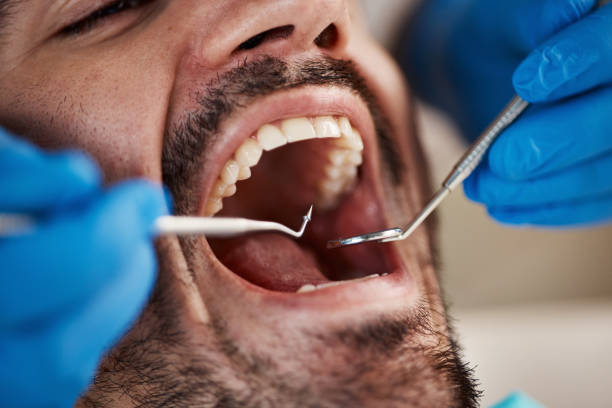 Best Emergency Dentist for Lost Fillings or Crowns in Lavallette, NJ